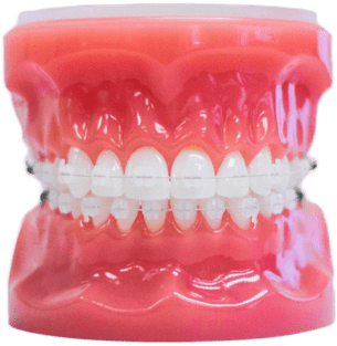 clear braces on plastic model for Ossi Orthodontics