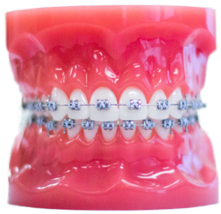 metal braces on plastic model for Ossi Orthodontics